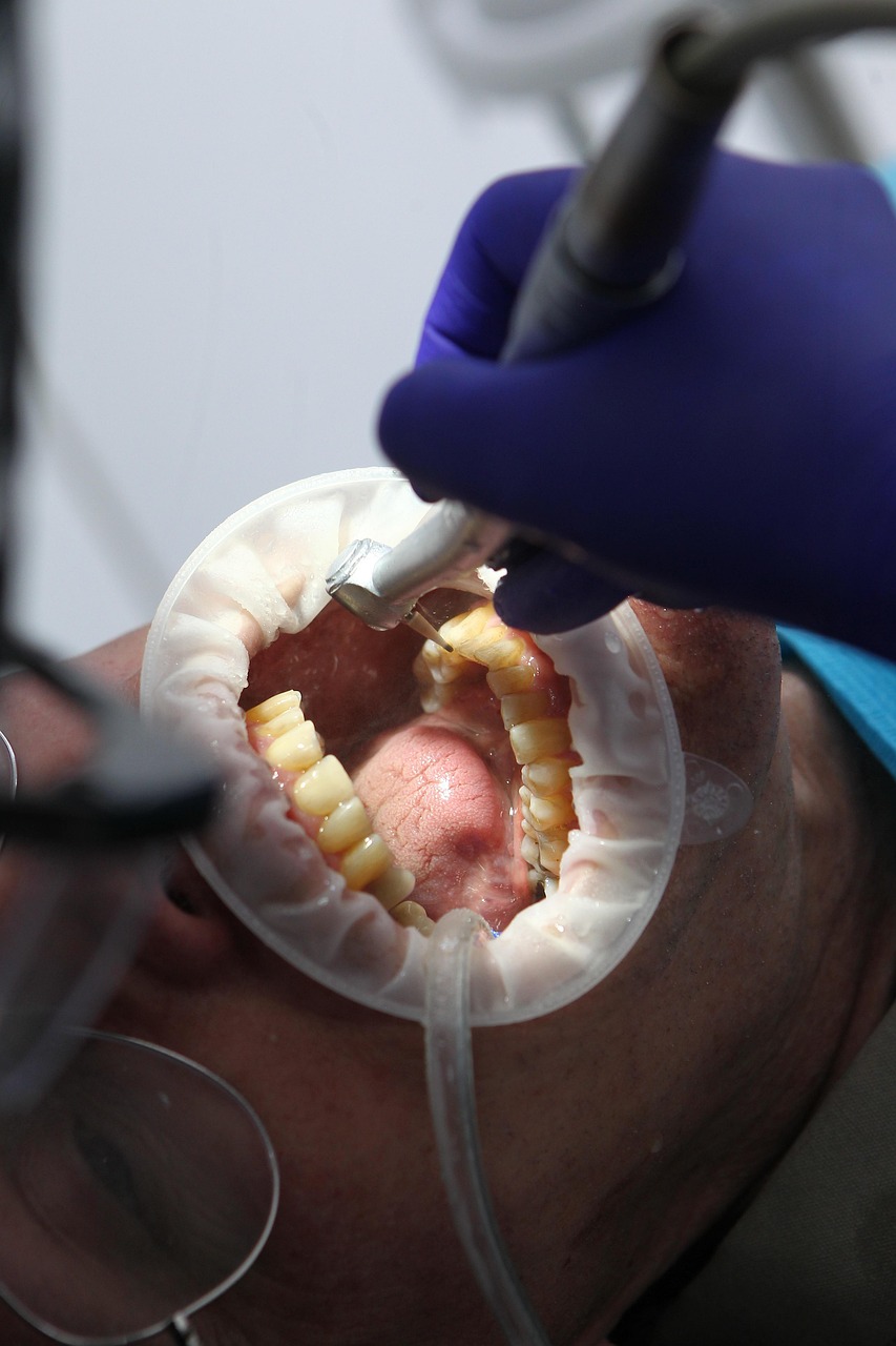 Damon Braces